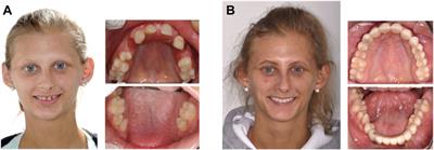 Ectodermal dysplasias: New perspectives on the treatment of so far immedicable genetic disorders